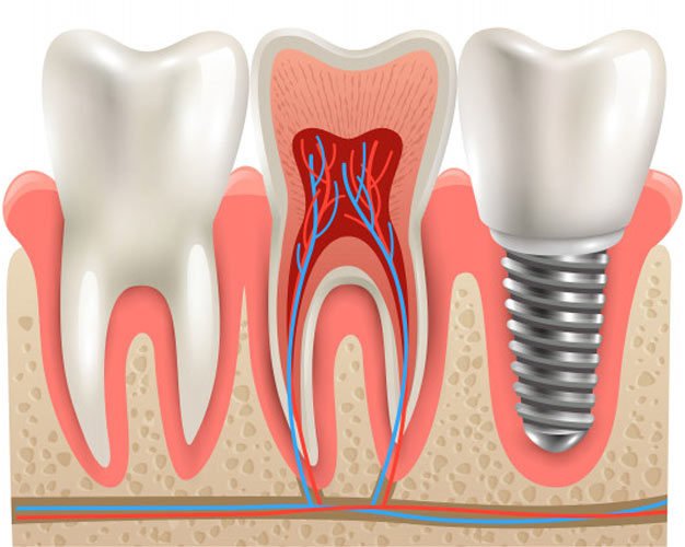 Best Dentist in Bangalore for dental implants