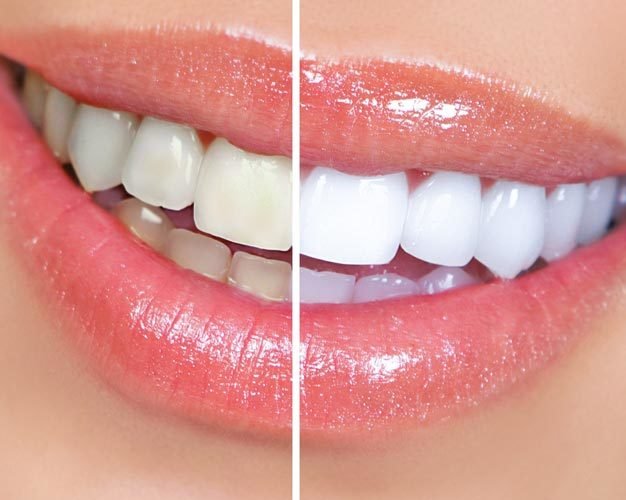 Maxillofacial Prosthetic