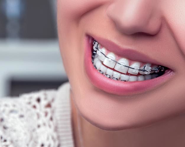 Orthodontic Corrections in Bangalore