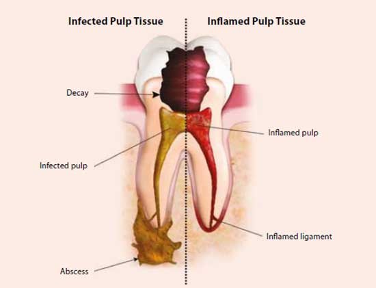 Root canal treatment