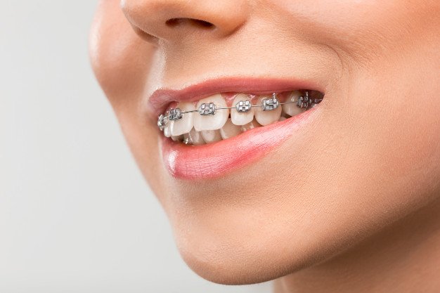 Different Ways in Which Braces Can Prove To Be Very Helpful