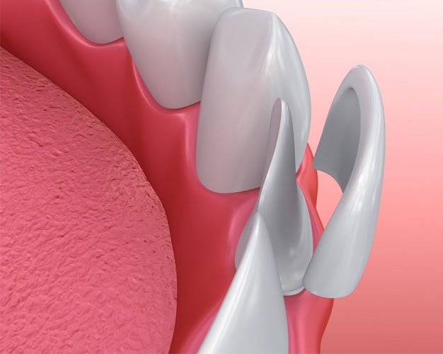 Best Dentist for Dental Veneers & porcelain veneer treatment