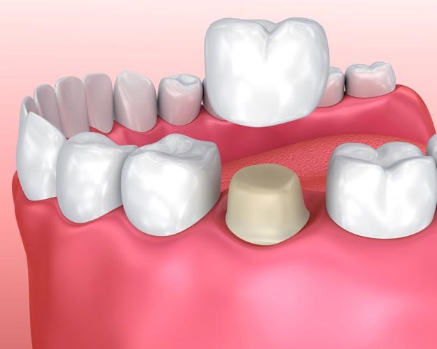 dental crowns and caps treatment in Bangalore