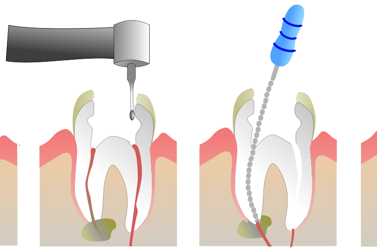 Best Root canal Treatment in Bangalore
