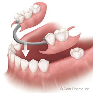 types-of-full-dentures